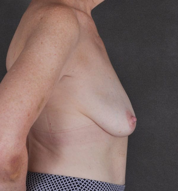 breast lift - patient 9807 - before 3 breast lift - patient 9807 - before 3