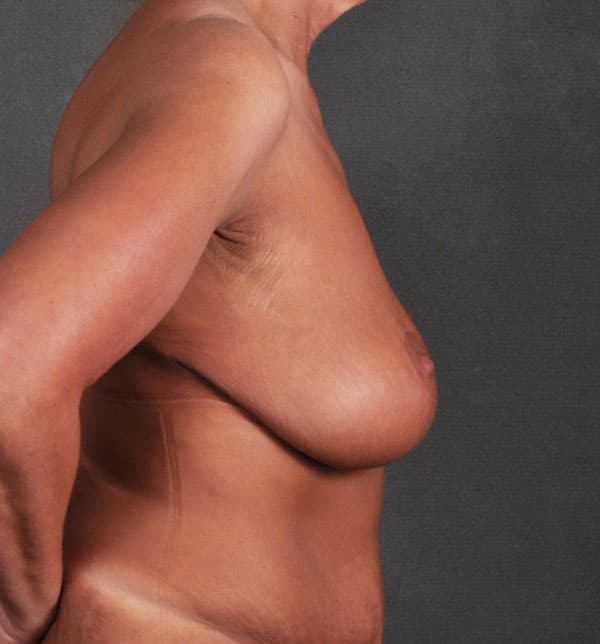 breast lift - patient 9746 - after 3 breast lift - patient 9746 - after 3
