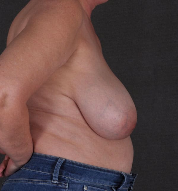 breast reduction - patient 9844 - before 3 breast reduction - patient 9844 - before 3