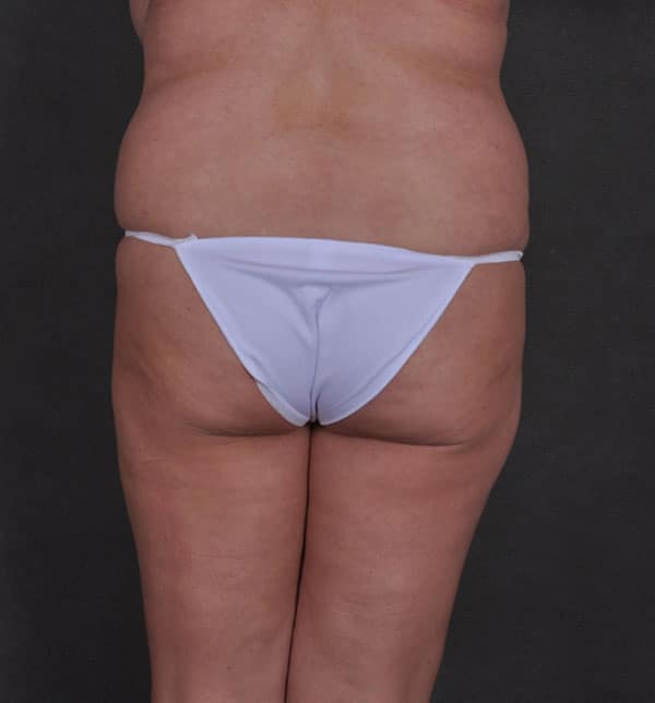 tummy tuck - patient 9833 - before 4 tummy tuck - patient 9833 - before 4