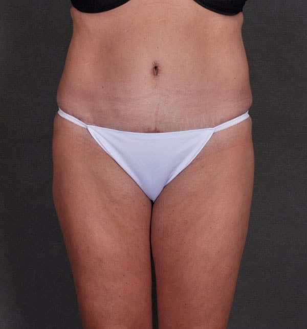 tummy tuck - patient 9833 - after 1 tummy tuck - patient 9833 - after 1