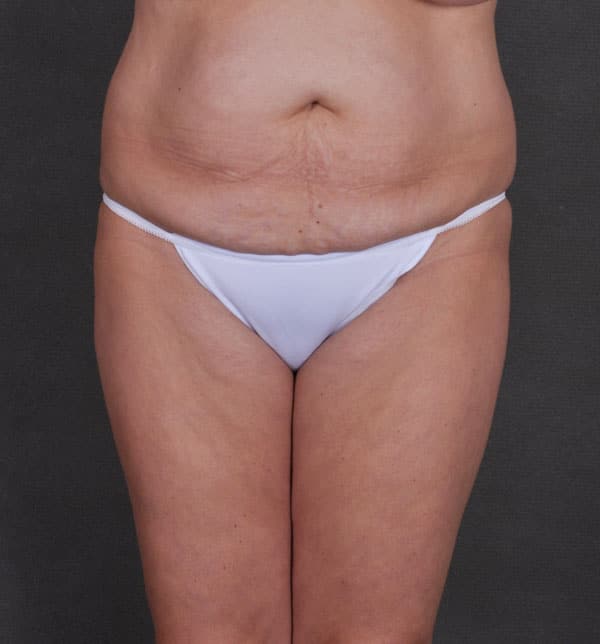 tummy tuck - patient 9833 - before 1 tummy tuck - patient 9833 - before 1