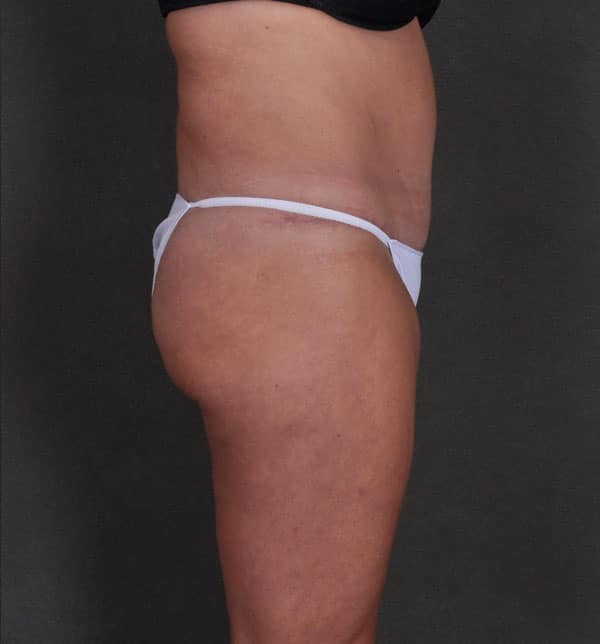 tummy tuck - patient 9833 - after 3 tummy tuck - patient 9833 - after 3