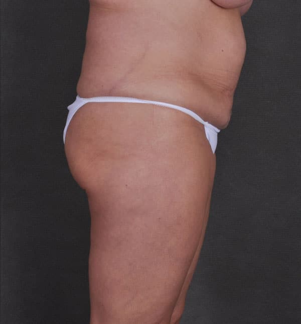 tummy tuck - patient 9833 - before 3 tummy tuck - patient 9833 - before 3