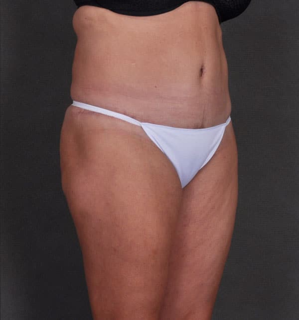 tummy tuck - patient 9833 - after 2 tummy tuck - patient 9833 - after 2
