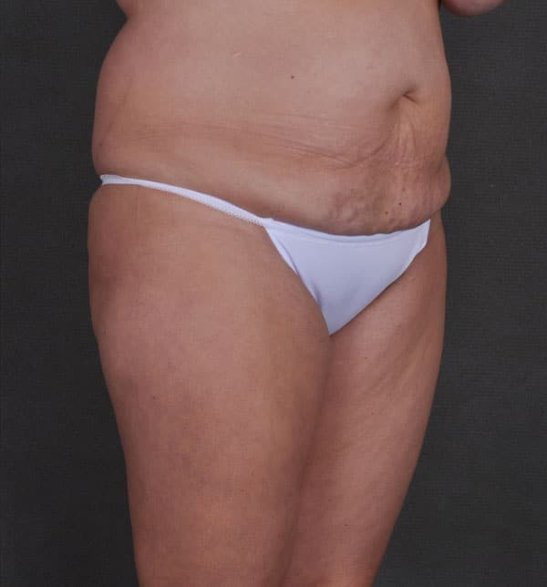 tummy tuck - patient 9833 - before 2 tummy tuck - patient 9833 - before 2