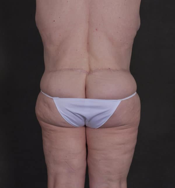liposuction - patient 9834 - after 4 liposuction - patient 9834 - after 4