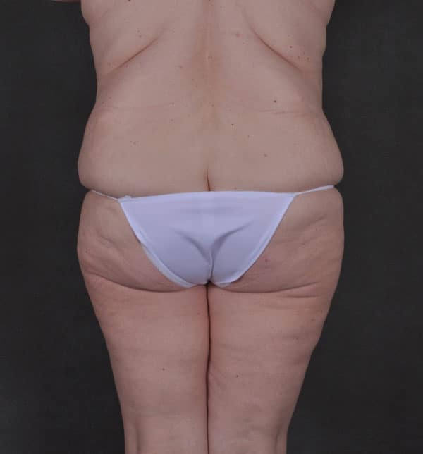 liposuction - patient 9834 - before 4 liposuction - patient 9834 - before 4