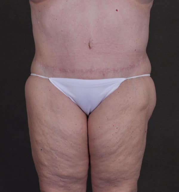 liposuction - patient 9834 - after 1 liposuction - patient 9834 - after 1