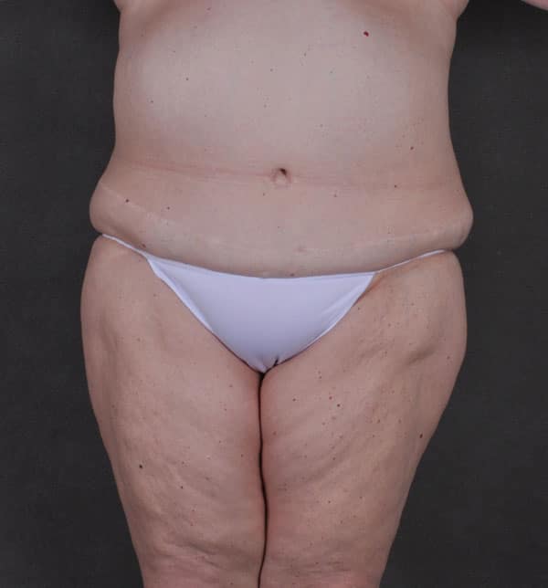 liposuction - patient 9834 - before 1 liposuction - patient 9834 - before 1