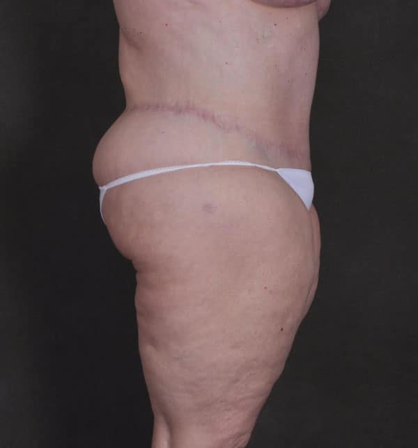 liposuction - patient 9834 - after 3 liposuction - patient 9834 - after 3