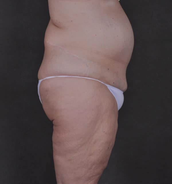 liposuction - patient 9834 - before 3 liposuction - patient 9834 - before 3