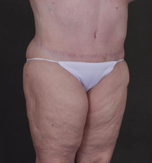 liposuction - patient 9834 - after 2 liposuction - patient 9834 - after 2