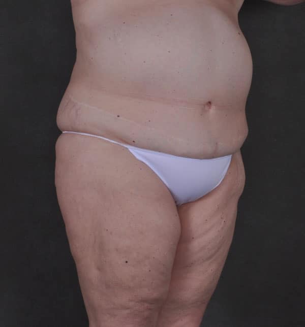liposuction - patient 9834 - before 2 liposuction - patient 9834 - before 2