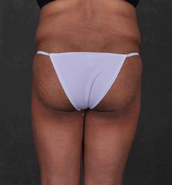 liposuction - patient 9868 - before 4 liposuction - patient 9868 - before 4