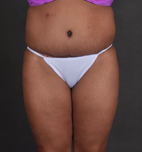 liposuction - patient 9868 - after 1 liposuction - patient 9868 - after 1