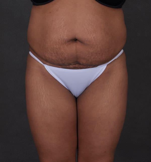 liposuction - patient 9868 - before 1 liposuction - patient 9868 - before 1