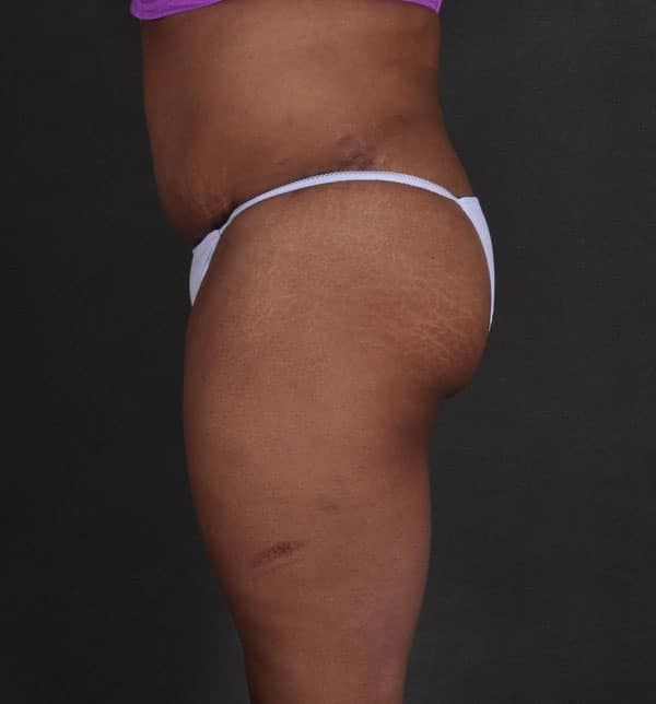 liposuction - patient 9868 - after 3 liposuction - patient 9868 - after 3