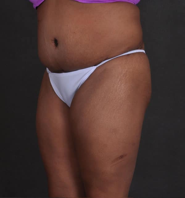 liposuction - patient 9868 - after 2 liposuction - patient 9868 - after 2