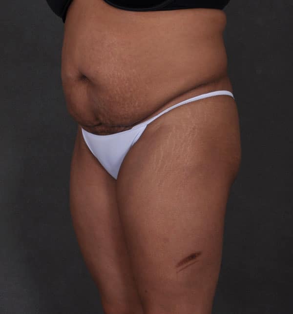 liposuction - patient 9868 - before 2 liposuction - patient 9868 - before 2