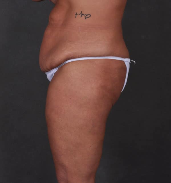 breast lift - patient 9907 - before 7 breast lift - patient 9907 - before 7
