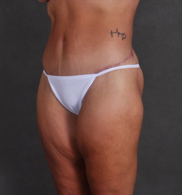 breast lift - patient 9907 - after 6 breast lift - patient 9907 - after 6