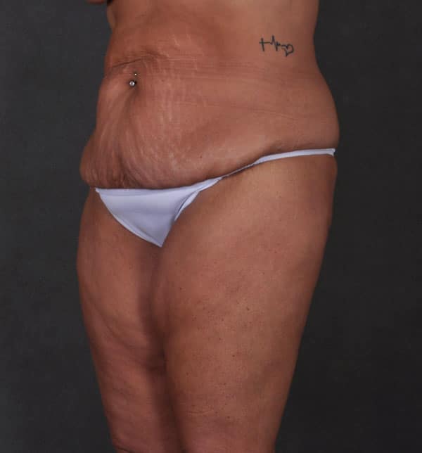 breast lift - patient 9907 - before 6 breast lift - patient 9907 - before 6