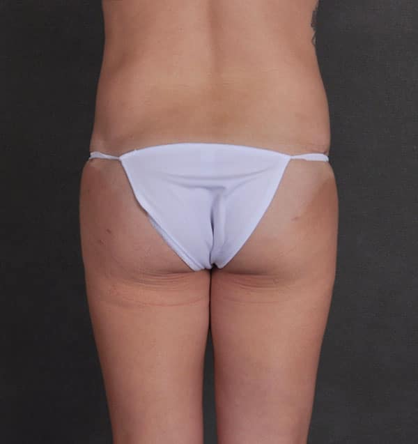 tummy tuck - patient 9770 - after 7 tummy tuck - patient 9770 - after 7