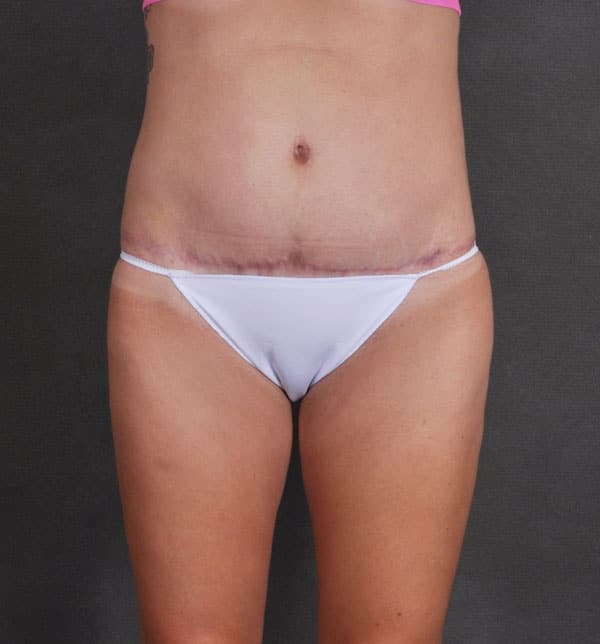 tummy tuck - patient 9770 - after 4 tummy tuck - patient 9770 - after 4