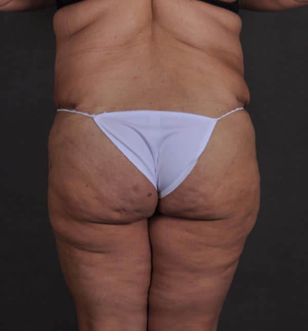 tummy tuck - patient 9660 - after 4 tummy tuck - patient 9660 - after 4