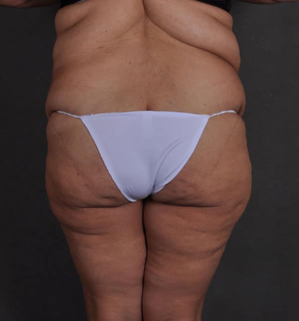 tummy tuck - patient 9660 - before 4 tummy tuck - patient 9660 - before 4