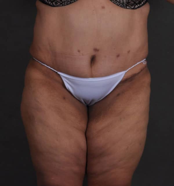 tummy tuck - patient 9660 - after 1 tummy tuck - patient 9660 - after 1