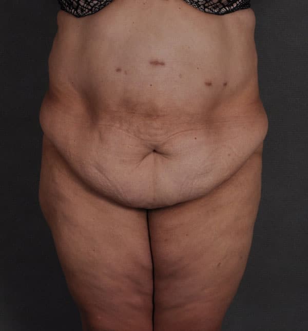 tummy tuck - patient 9660 - before 1 tummy tuck - patient 9660 - before 1