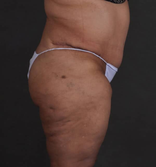 tummy tuck - patient 9660 - after 3 tummy tuck - patient 9660 - after 3
