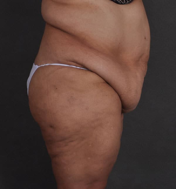 tummy tuck - patient 9660 - before 3 tummy tuck - patient 9660 - before 3