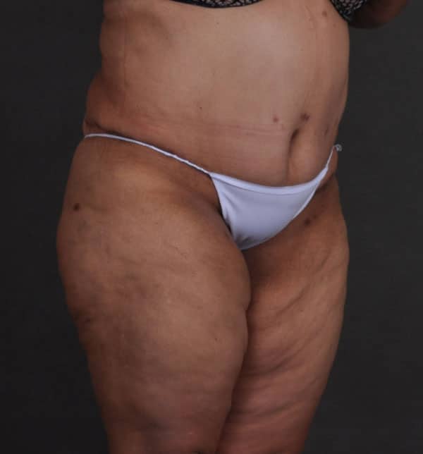 tummy tuck - patient 9660 - after 2 tummy tuck - patient 9660 - after 2