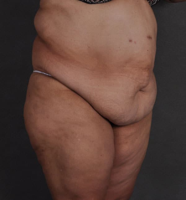 tummy tuck - patient 9660 - before 2 tummy tuck - patient 9660 - before 2
