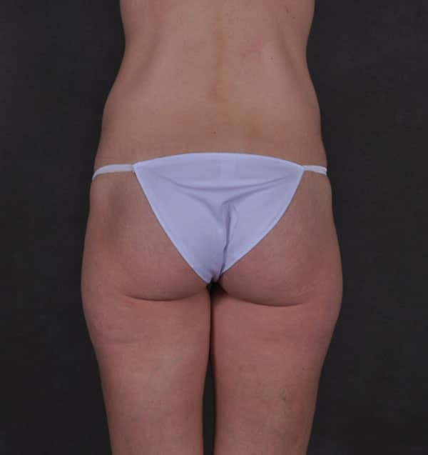 tummy tuck - patient 9870 - before 3 tummy tuck - patient 9870 - before 3