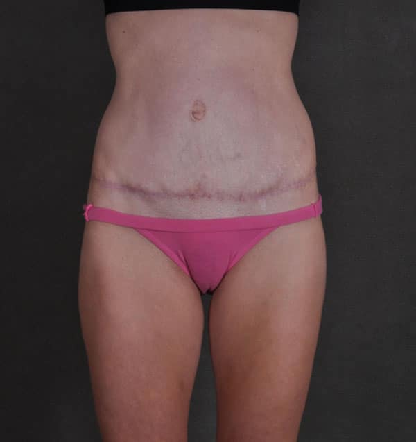 tummy tuck - patient 9870 - after 1 tummy tuck - patient 9870 - after 1