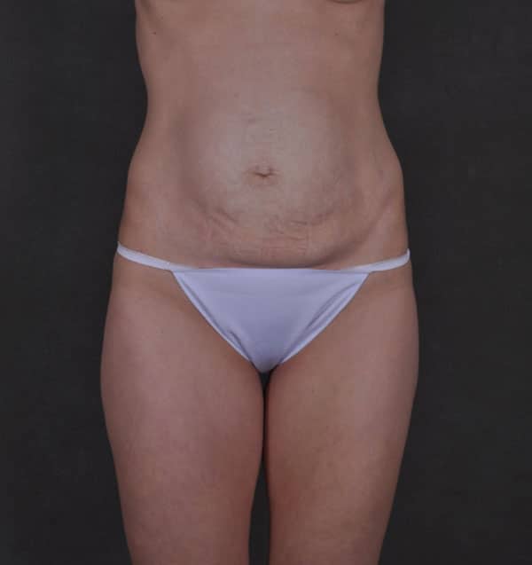 tummy tuck - patient 9870 - before 1 tummy tuck - patient 9870 - before 1