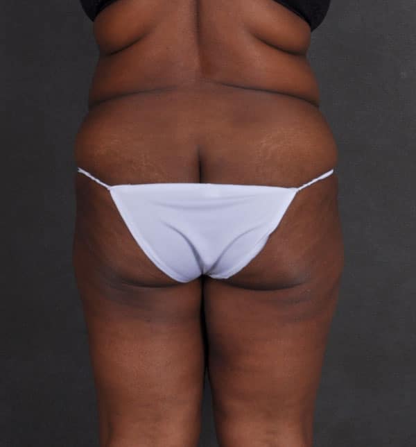 liposuction - patient 9886 - before 4 liposuction - patient 9886 - before 4