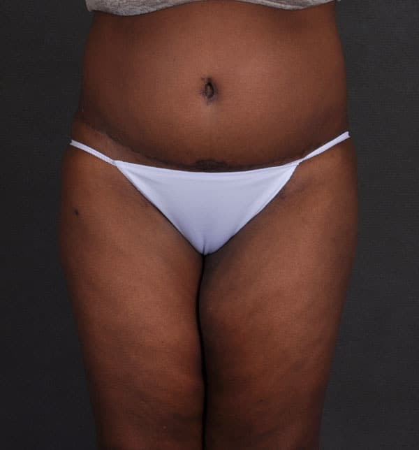 liposuction - patient 9886 - after 1 liposuction - patient 9886 - after 1