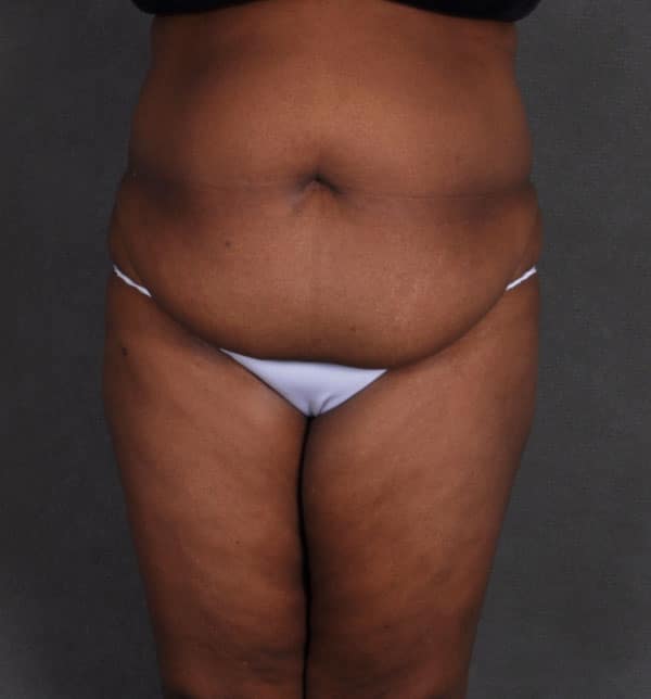 liposuction - patient 9886 - before 1 liposuction - patient 9886 - before 1