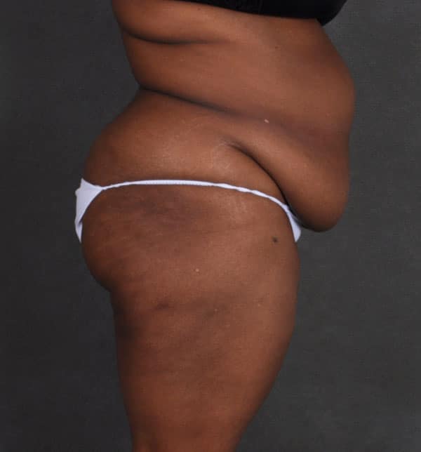 liposuction - patient 9886 - before 3 liposuction - patient 9886 - before 3