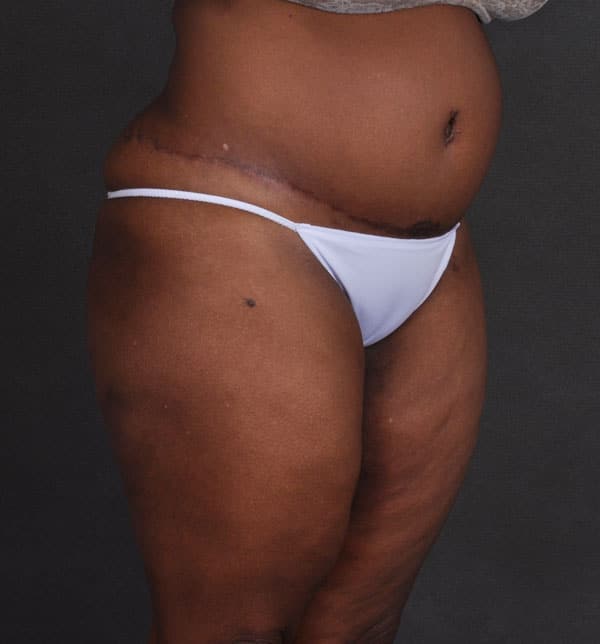 liposuction - patient 9886 - after 2 liposuction - patient 9886 - after 2