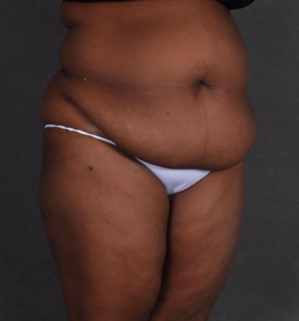 liposuction - patient 9886 - before 2 liposuction - patient 9886 - before 2