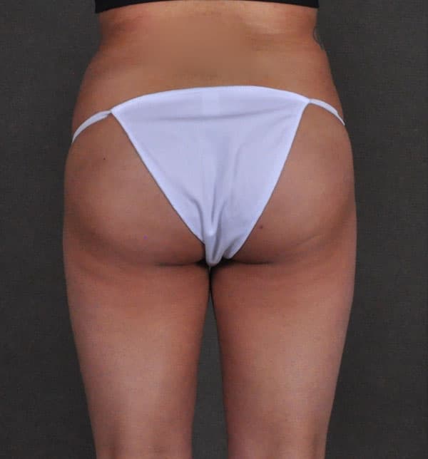 brazilian butt lift - patient 9946 - after 4 brazilian butt lift - patient 9946 - after 4