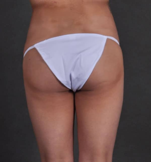 brazilian butt lift - patient 9946 - before 4 brazilian butt lift - patient 9946 - before 4