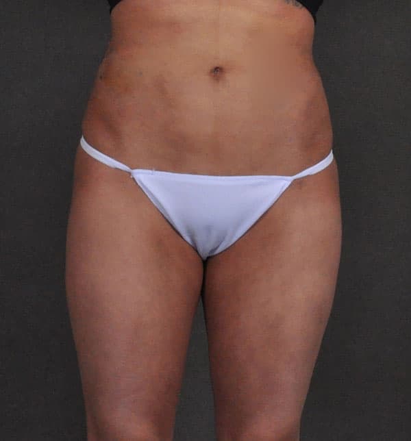 brazilian butt lift - patient 9946 - after 1 brazilian butt lift - patient 9946 - after 1