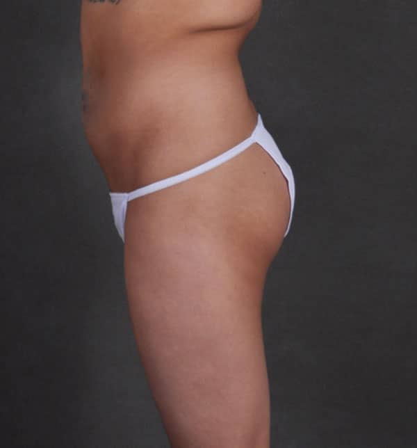brazilian butt lift - patient 9946 - before 3 brazilian butt lift - patient 9946 - before 3